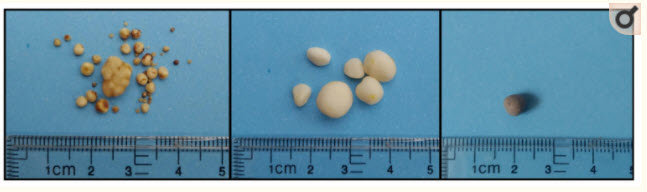 picture of cystine uroliths